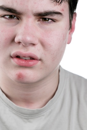 Efficient Acne Therapy Guide About The Way To Very Best And Successful Acne Therapy Fotolia 5391512 XS Efficient Acne Therapy Guide About The Way To Very Best And Successful Acne Therapy